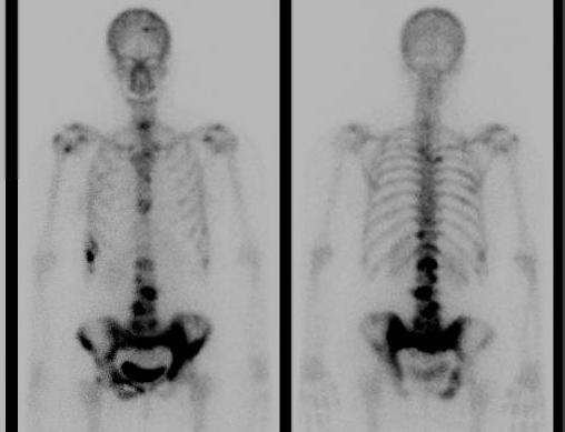 Bone scan Metastasis0002